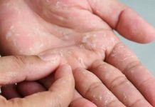 যে ভিটামিনের অভাবে হাত-পায়ের চামড়া ওঠে